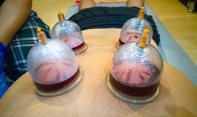 Person receiving wet cupping treatment
